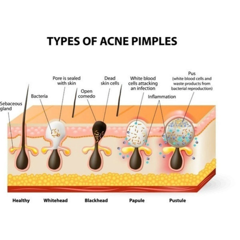TIRA PARA LA NARIZ – ADIÓS PUNTOS NEGROS EN UNA SOLA APLICACIÓN