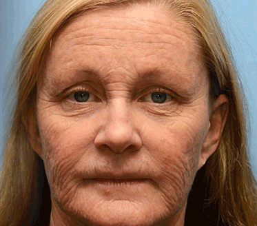 BEE VENOM - EL ELIXIR REJUVENECEDOR PARA LA PIEL DE 50+