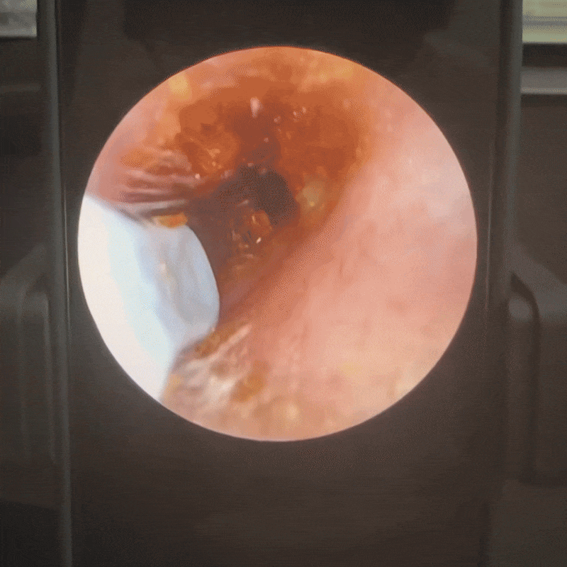 MÁQUINA DE CUIDADO DE OÍDOS SEGURA CON ESTÁNDARES INTERNACIONALES